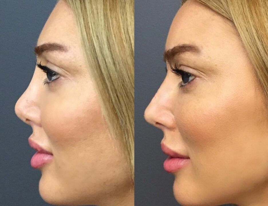 Escultura nasal
