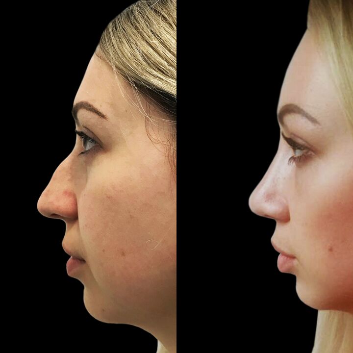 Rinoplastia
