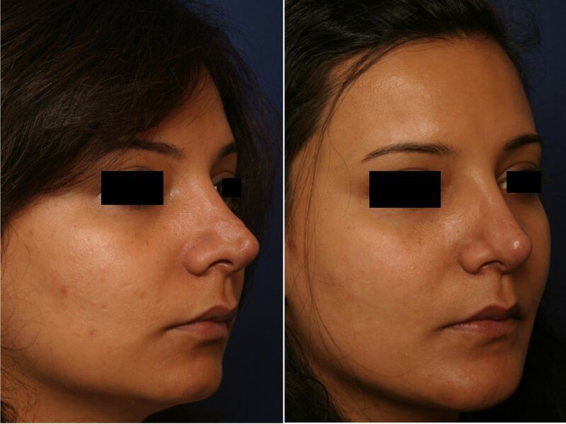 Resultado da cirurxía plástica