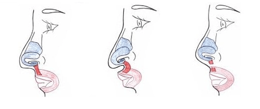 Acurtamento de parte do músculo nasal