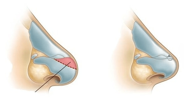 Corrección da forma do nariz