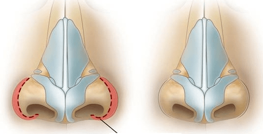 Redución das fosas nasais