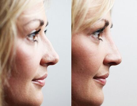 Antes e despois de rinoplastia con recheos