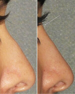 Antes e despois de rinoplastia non cirúrxica