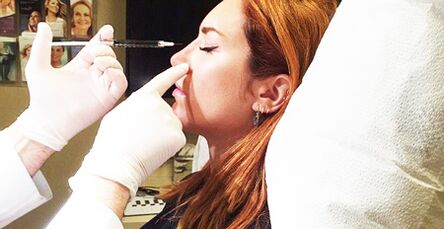 Rinoplastia con rellenos