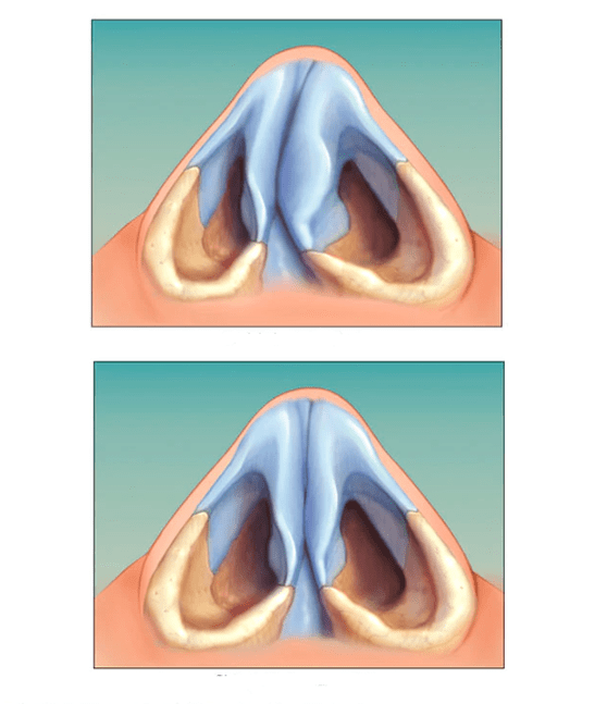 tabique nasal corrixido