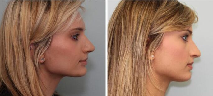 Resultados da rinoplastia antes e despois