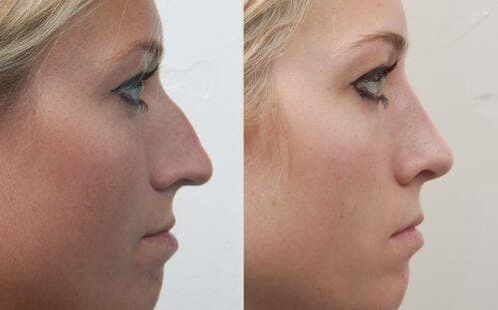 Antes e despois de rinoplastia non cirúrxica