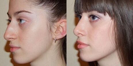 Fotos antes e despois da rinoplastia