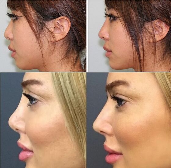 Fotos antes e despois da rinoplastia non cirúrxica