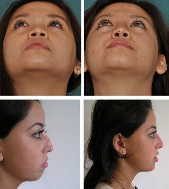 Fotos antes e despois da rinoplastia sen cirurxía