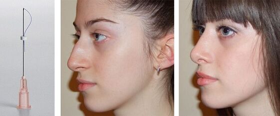 antes e despois da rinoplastia con fíos mesotras