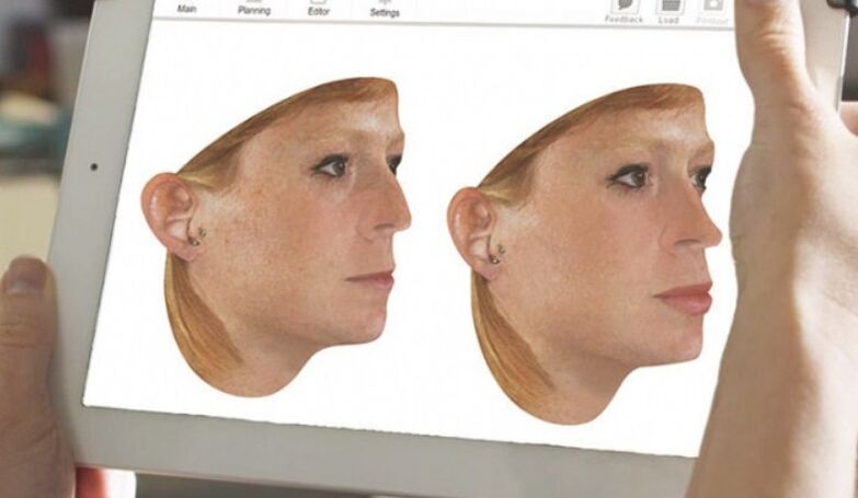 Método de modelado informático do nariz antes da rinoplastia
