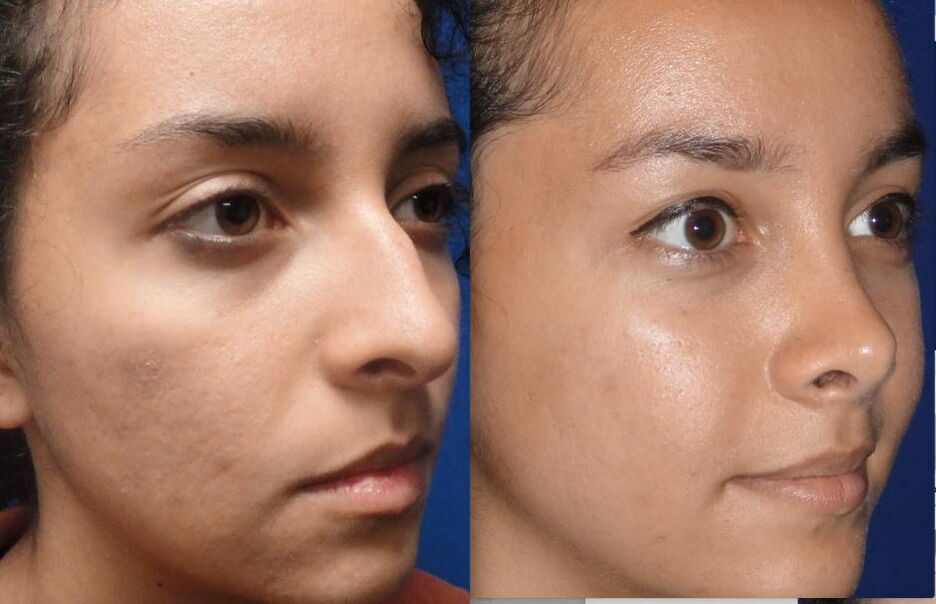 Fotos de antes e despois de rinoplastia pechada
