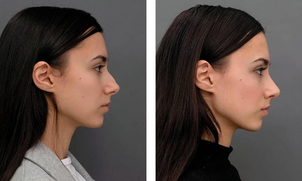 Fotos antes e despois da rinoplastia