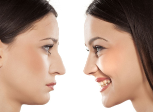 Rinoplastia nariz antes e despois