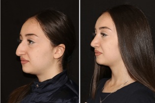 O resultado do alisado do nariz, despois de rinoplastia