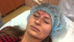 O suturas son introducidos baixo a pel do nariz