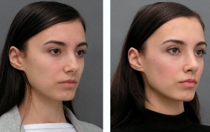 Rapaza antes e despois de rinoplastia nariz