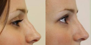 a punta do nariz antes e despois